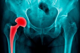 Arthrose de la hanche