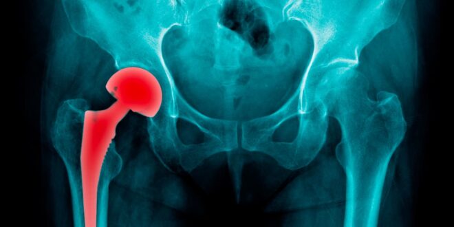 Arthrose de la hanche