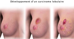 Le carcinome lobulaire in situ et infiltrant 1 1200x700 1