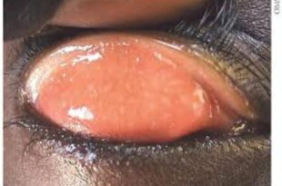 Trachome: Le Sénégal rejoint le groupe de pays qui l'ont éliminé    1 Screenshot 20250715 162612 Google