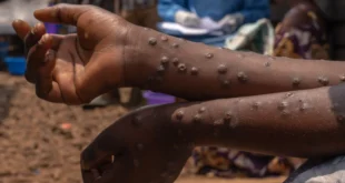 WELL MPOX QUESTIONS1 hcqt superJumbo