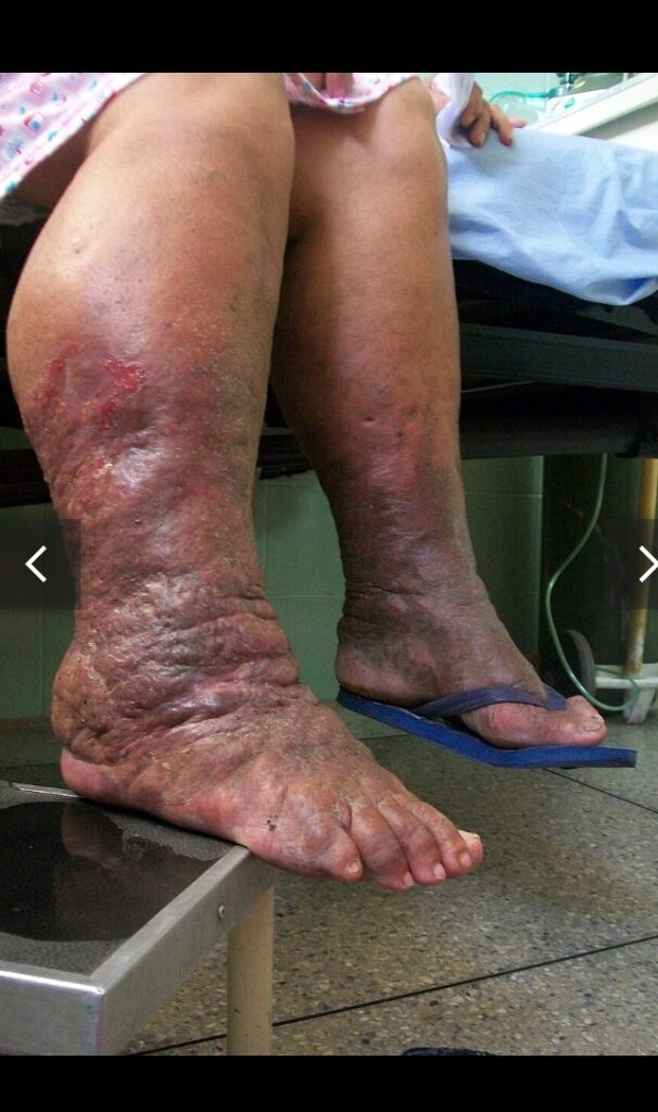 Le lymphœdème : Une maladie fréquente mais négligée 1 Screenshot 20260307 002124 1